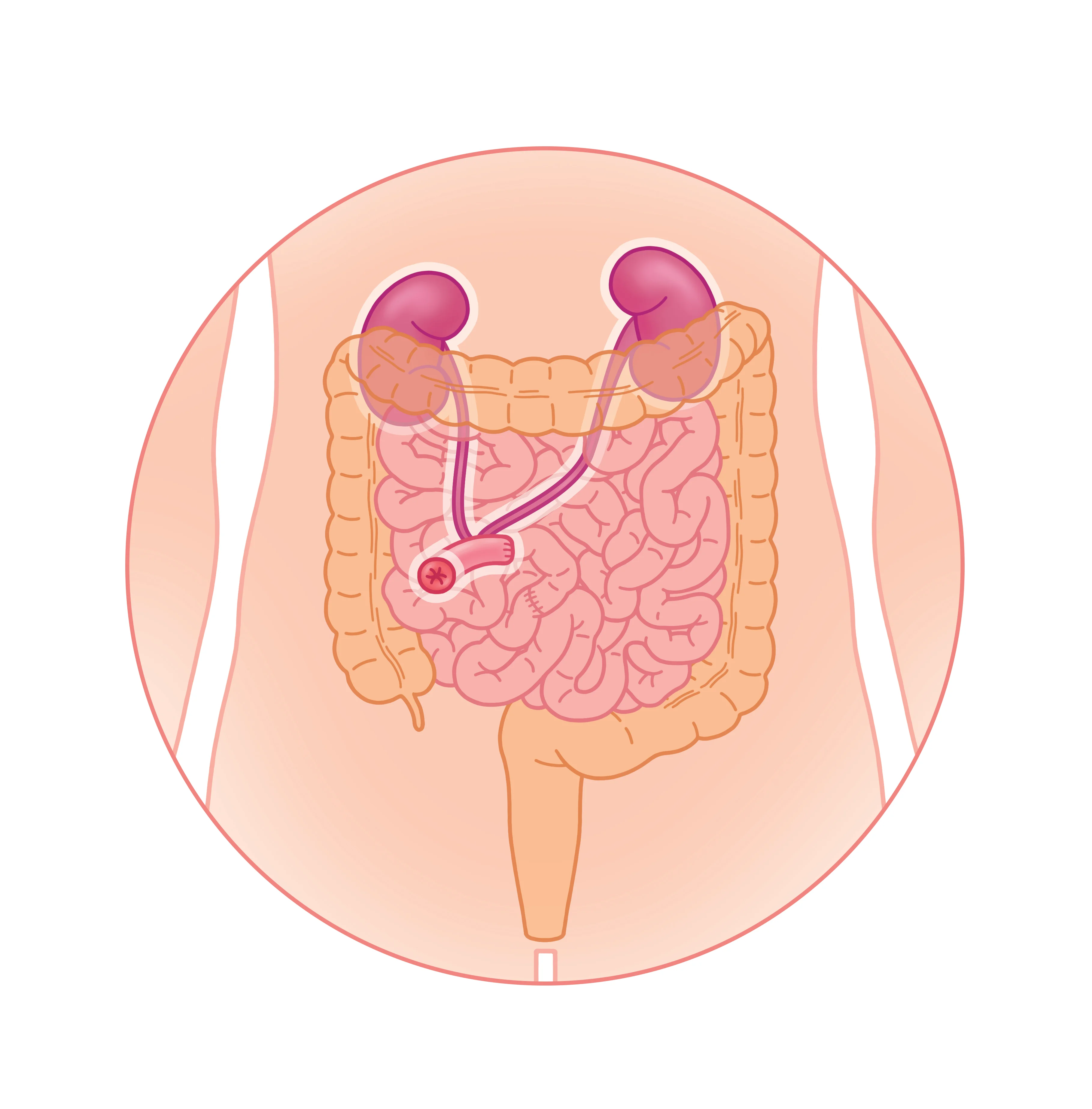 Chirurgie d’urostomie