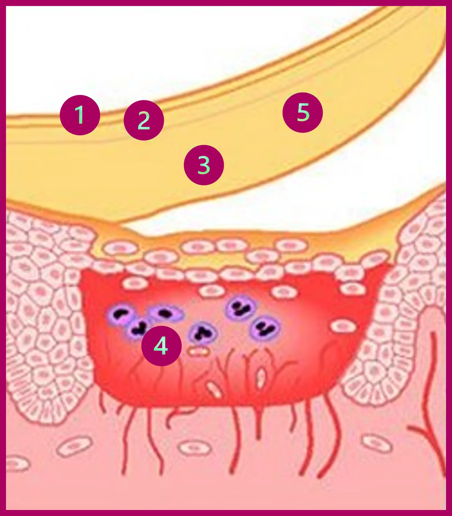 Comment fonctionnent les pansements DuoDERM