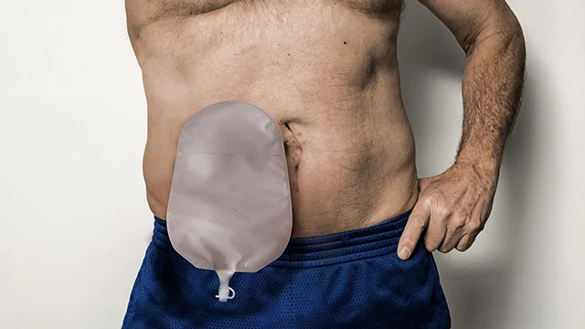 Picture of the Esteem Body™ urostomy pouch