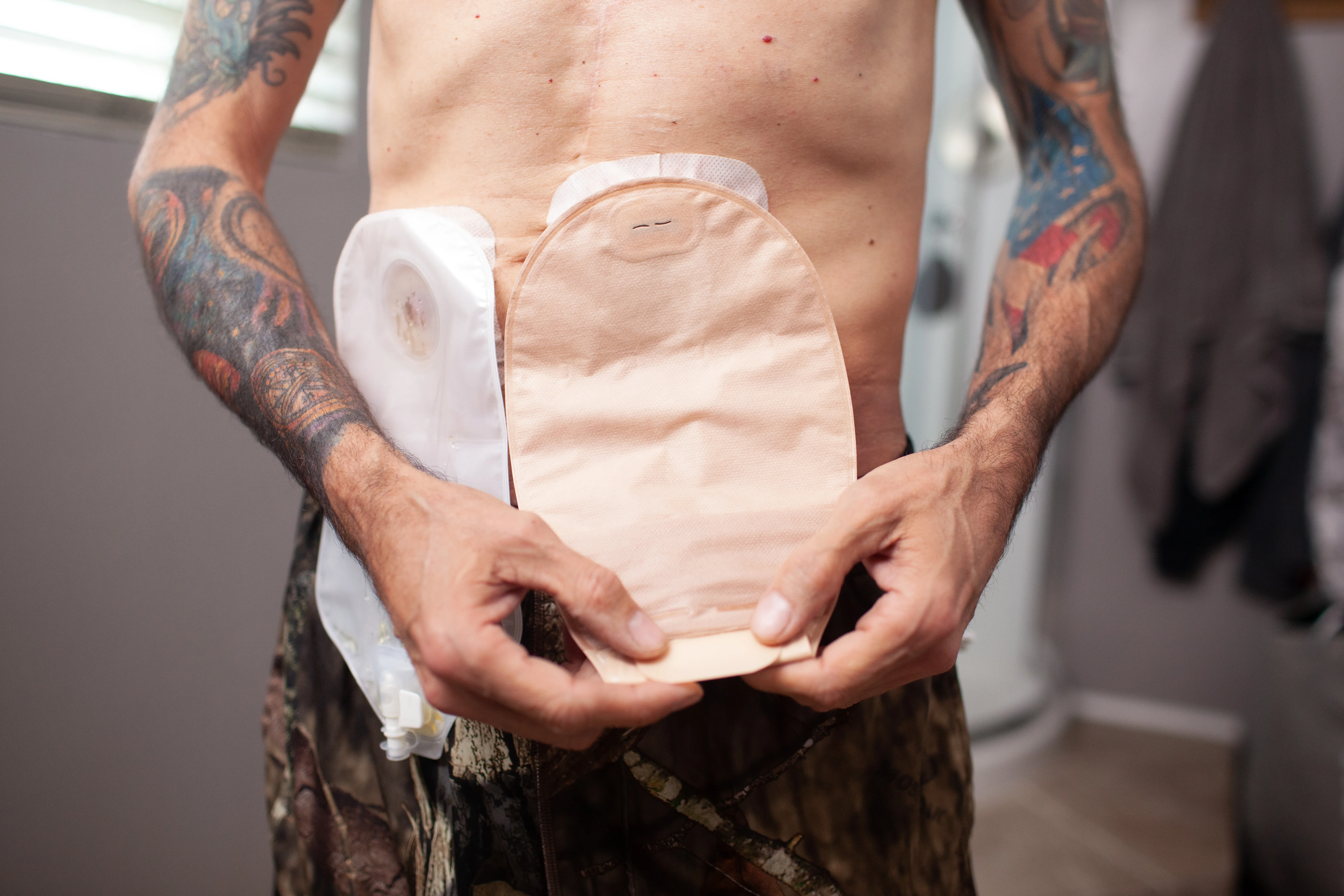 a man with an ostomy