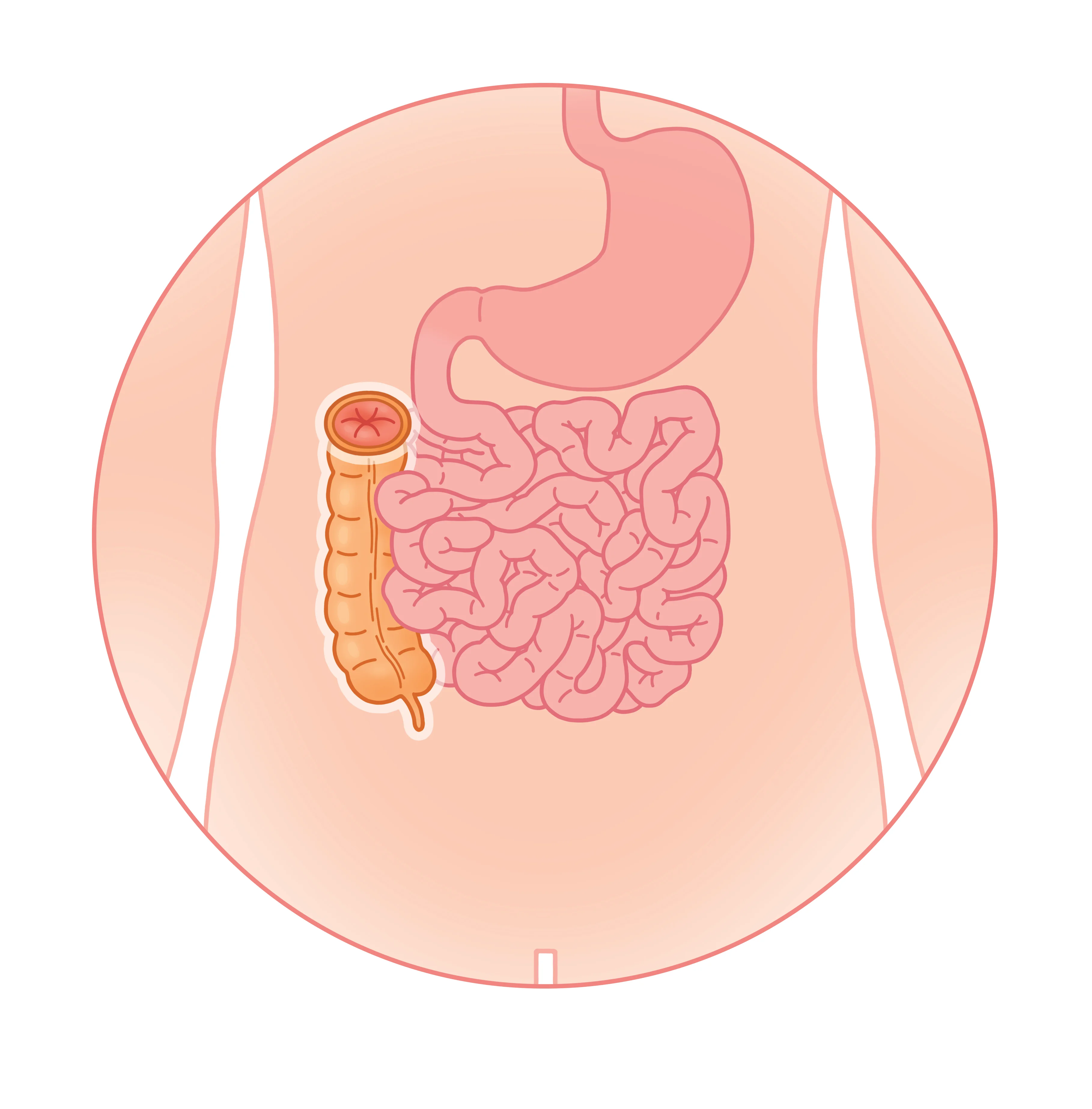 Création chirurgicale d'une colostomie